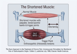Trigger Points in Shortened Muscle Image